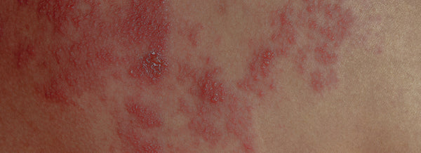 04---Blog---Dermatite-01