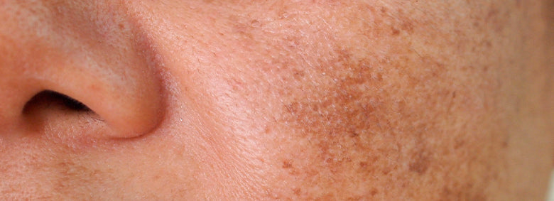 06---Blog---Melasma-01
